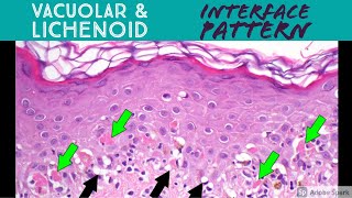 Vacuolar vs Lichenoid Interface Dermatitis Pattern  Inflammatory Dermpath Basics [upl. by Dar]