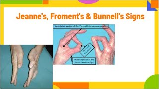 jeannes froments amp Bunnells signs  ulnar neuropathy PhysiotherapyKnowledge [upl. by Oiludbo275]