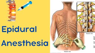 Epidural Anesthesia [upl. by Biernat734]