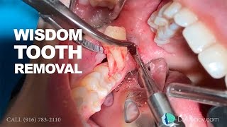 Wisdom tooth removal in 5 MIN or less Surgical Guide Online Course  Free eBook [upl. by Adia]