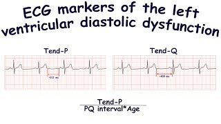 ECG markers of the left ventricular diastolic dysfunction TendP TendQ [upl. by Ahders]