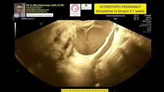 Heterotopic Pregnancy  Intrauterine normal 6 weeks vs Ruptured Ectopic Pregnancy [upl. by Waltner932]