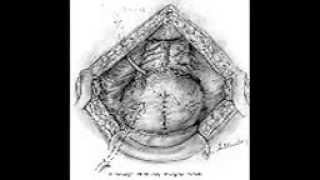 urology lecturs 4suprapubic Prostatectomy [upl. by Hannibal]