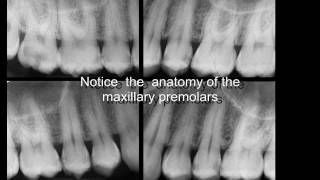 Three rooted maxillary premolars [upl. by Virg]