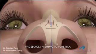 Rinoplastia em pessoas com nariz Largo e ponta mal definida [upl. by Ixel624]