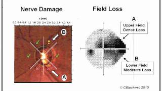 Glaucoma 1 Diagnosis [upl. by Roxi]