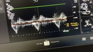 Severe Aortic regurgitation with Chronic Infective Endocarditis [upl. by Yht686]