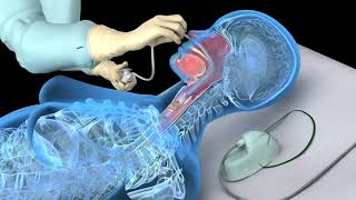 Nasotracheal suctioning NTS  3D animation [upl. by Thomajan523]