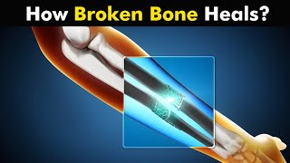 Process of Bone Healing  Bone Healing Steps UrduHindi [upl. by Aleakcim562]