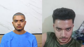 2nd PRP After Hair Transplant  PRP Treatment Bhopal  Stop Hairfall  teenage [upl. by Shenan328]