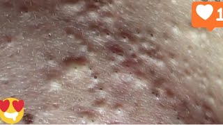 The Back Is Full Of Blackheads pimple blackheadremoval acne removal [upl. by Barb653]