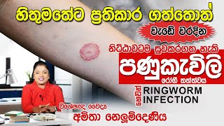 පණුකැවිලි රෝගය හෙවත් Ringworm infection සදහා ප්‍රතිකාර  Skin Specialist [upl. by Hike]