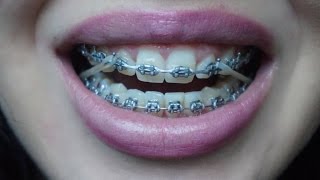 BracesOrtho update Closeup elastics gone wrong and more [upl. by Trinia]