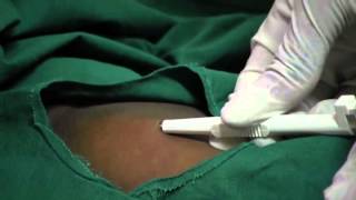 Contraceptive Implants  11  Procedure Insert implant [upl. by Warton166]