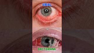 conjuntivitis viral vs Bacteriana salud conjuntivitis diferencias viral bacteriana [upl. by Christalle216]