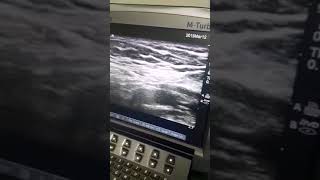 US guided genitofemoral nerve block [upl. by Dawes943]