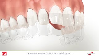 Treatment of Malocclusion Teeth with Invisible Splint [upl. by Rexford826]