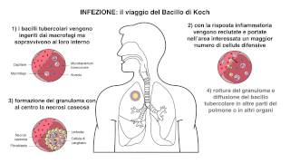 Video Patogenesi Tubercolosi [upl. by Alakim]