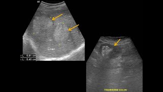 metastatic liver cancer 전이성 간암 [upl. by Parshall381]