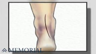 Achilles Tendon Repair Surgery [upl. by Meeki]