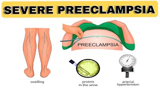 Severe Preeclampsia  NCLEX REVIEW [upl. by Coffin]