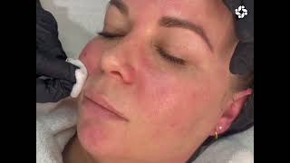 RADIANT REJUVENATION THE MESOBRITE™ TREATMENT FOR MELASMA [upl. by Hacissej]