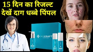 skinkraft for acne pimples kit skinkraft products uses side effectsskinkraft for acne scars [upl. by Crifasi891]