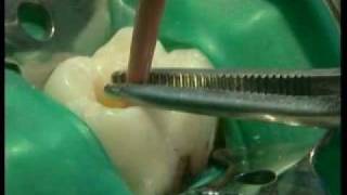 Endodontie mécanisée le système PROTAPER® principes et guide dutilisation [upl. by Nevur371]