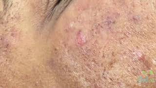 Black Head Extraction  Ezequiel  1st Treatment [upl. by Koerlin196]