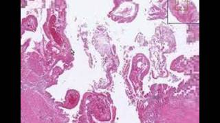 Histopathology GallbladderAcute cholecystitis [upl. by Stace190]