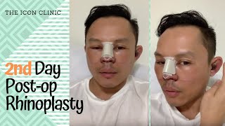 Rhinoplasty In the Philippines 2nd Day Post Opp [upl. by Romeyn]