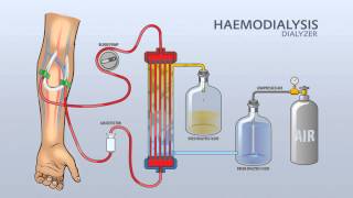 HAEMODIALYSIS DIALYZER [upl. by Bear]