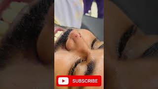 Laser Mole Removal  Mole तिल kaise nikale shortvideo viral doctor hospital skincare mole [upl. by Merlina]