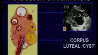 Sonographic Evaluation of the Ovary To Worry or not to Worry [upl. by Modesta]