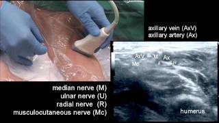 The Axillary Block [upl. by Ganley479]