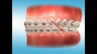 Advanced Orthodontics  Elastics [upl. by Zarihs]