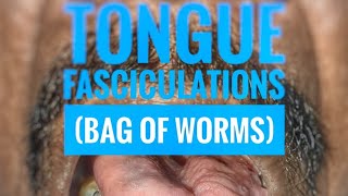 Tongue fasciculations quotBag of wormsquot  mbbs medicine neurology [upl. by Irtak]