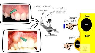 Adenomatoid odontogenic tumor [upl. by Blakeley798]