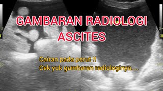 Radiologi ascites [upl. by Corrine]