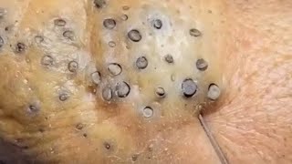 Extreme blackhead removal new 5498 poppingpimpless [upl. by Puritan680]