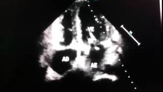 Echocardiography  Mitral valve vegetation  infectious endocarditis [upl. by Ylrebme]