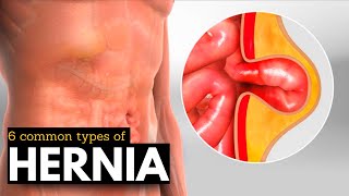 Hernia Breakdown Discovering the 6 Most Prevalent Types [upl. by Gamin]