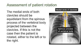 Assessment of Patient Rotation on Chest X ray [upl. by Hammer]