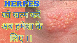 Herpes Treatment by the Simplest way by Asy Tips [upl. by Georgy]