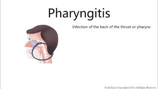 Viral pharyngitis [upl. by Bysshe]