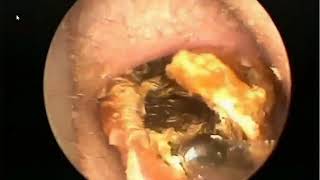 Earwax Removal Extractions UNEXPECTED SIZE Finally Part 3 清理耳内结痂 外耳道挖耳屎清理 耳垢 耳垢 [upl. by Meit]