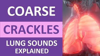 Coarse Crackles Lung Sounds Audio Causes Auscultation Nursing NCLEX Review [upl. by Mickelson]