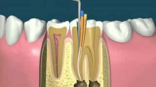 traitement endodontiquedevitalisationflv [upl. by Enelram]