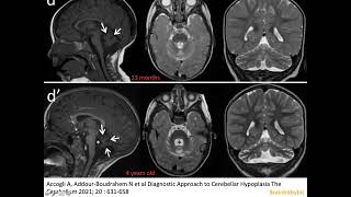 24 Pontocerebellar hypoplasia congenital cerebellar atrophy dragonfly rhombomeres neuroimaging [upl. by Mayrim]