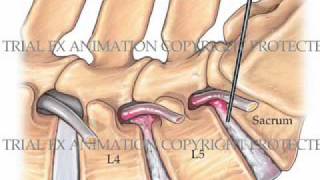 Percutaneous Discectomy Animation [upl. by Nylanej]